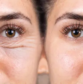 glaser_laser_anti-age