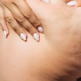 glaser_laser_cellulite