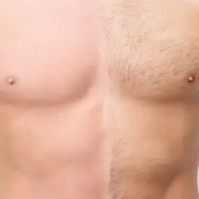 glaser_laser_epilation-homme