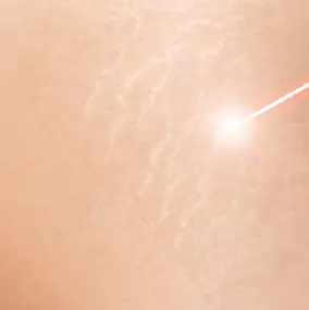glaser_laser_vergeture_